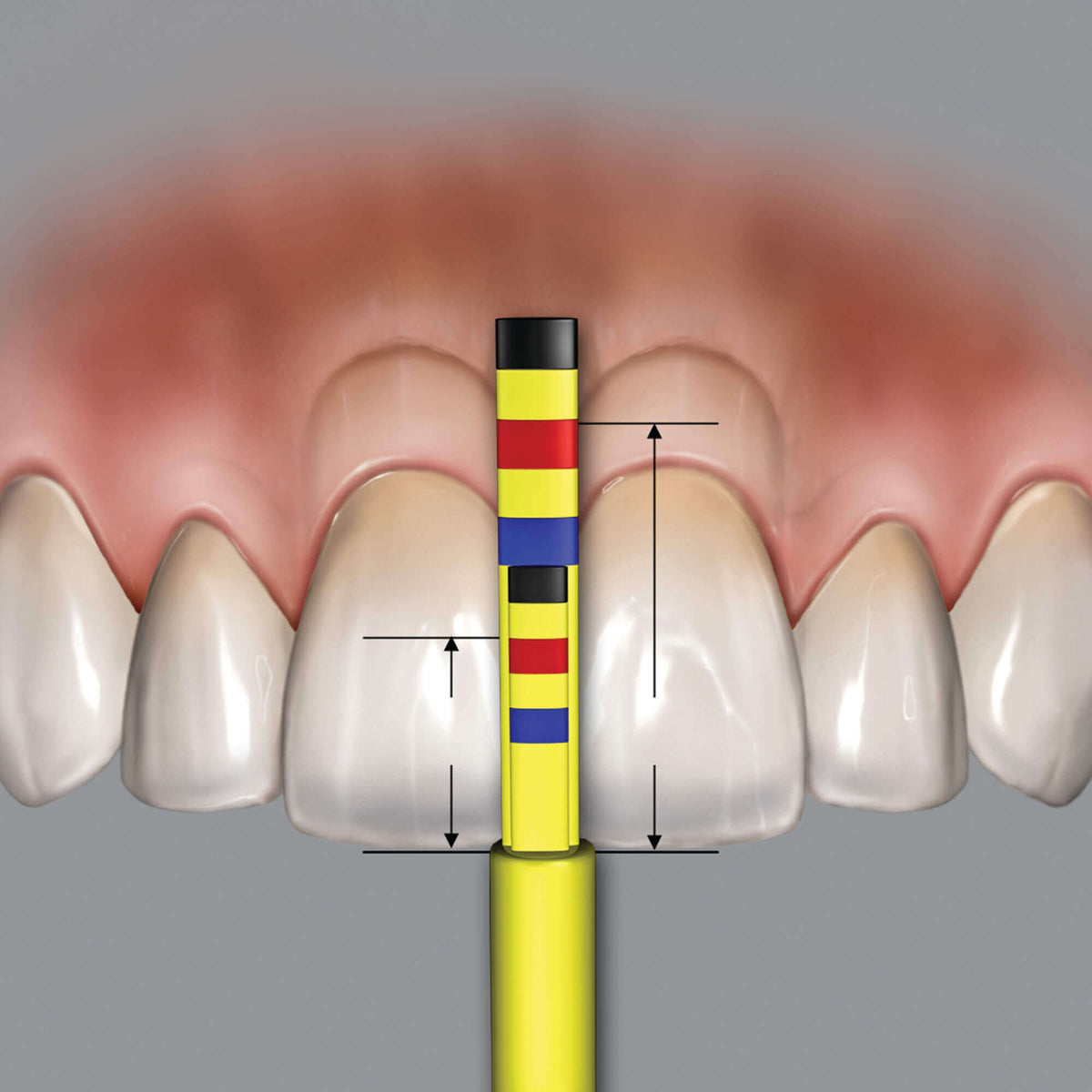 Papilla Replacement Tips - 3 Tips