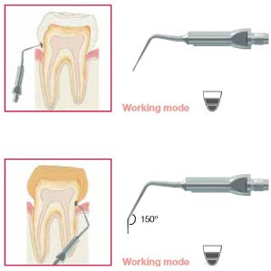 Biosonic Piezo Tips - Minimally Invasive Excavation