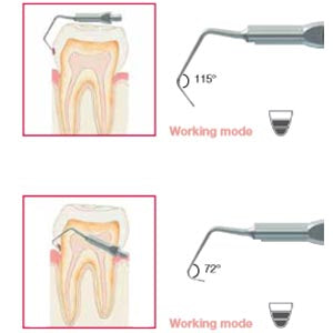 Biosonic Piezo Tips - Minimally Invasive Excavation