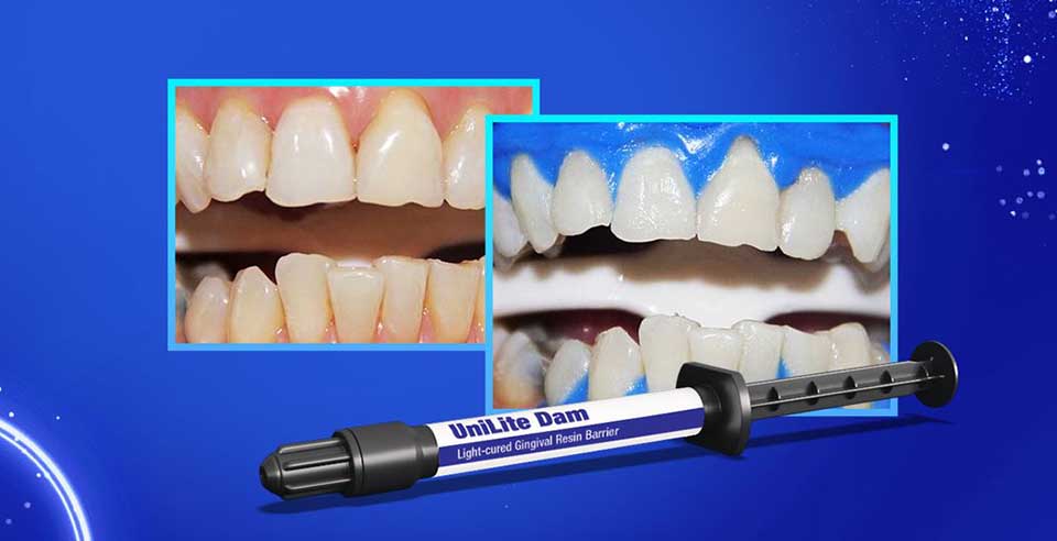 Utilizing Liquid Dam for Rubber Dam Placement