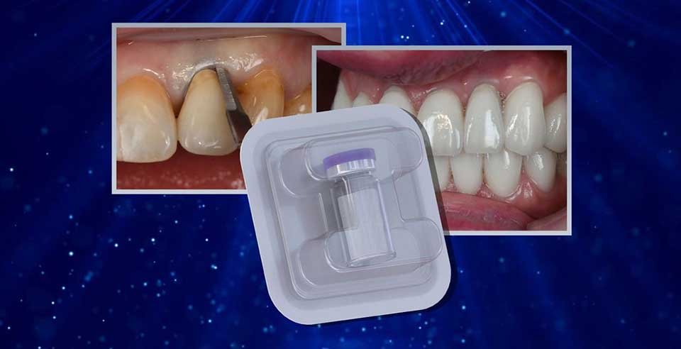 DSI Zenoss Matrix Bio+ - Restoration of Soft Tissue