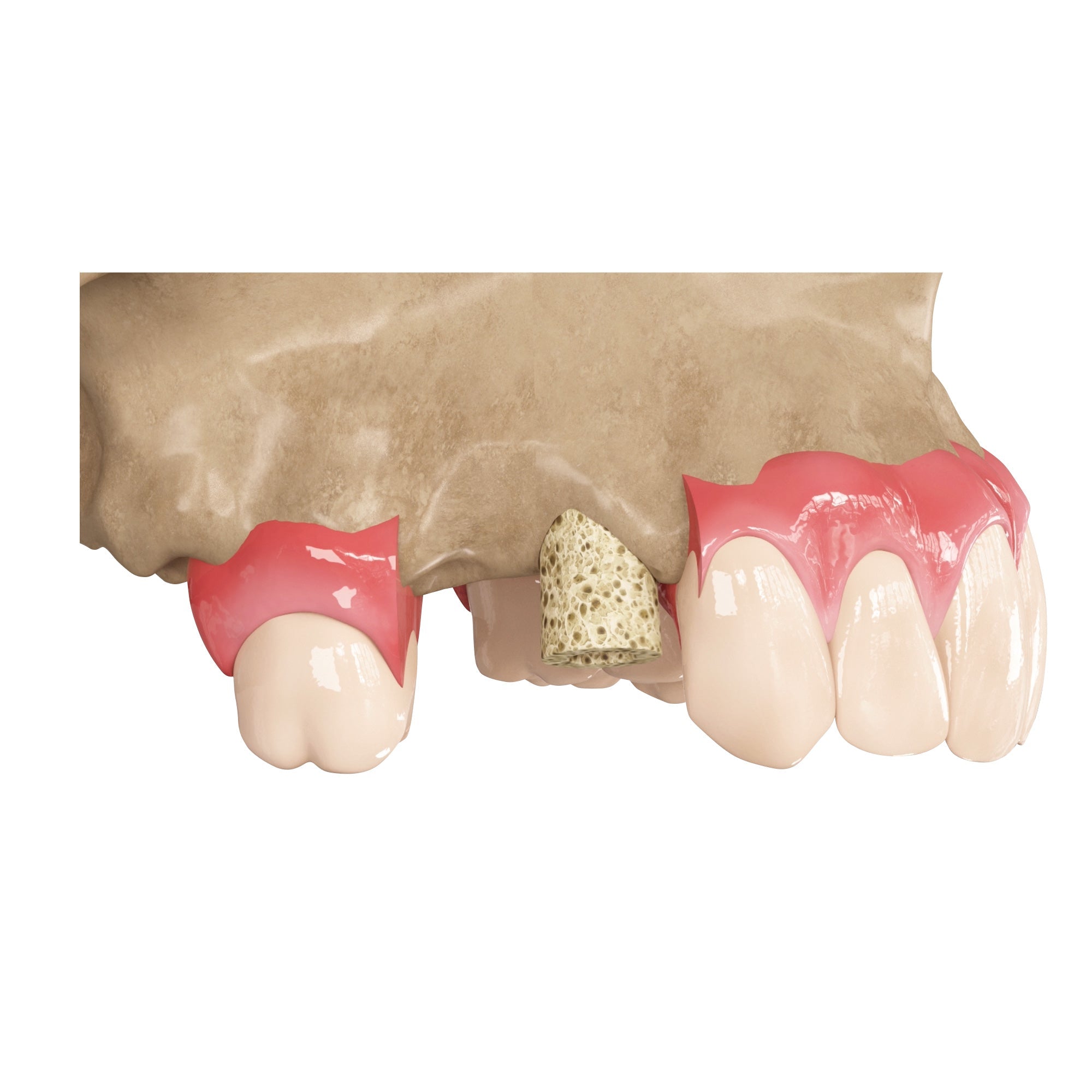 DSI Zenoss Bovine Natural Bone Graft Ring For Single Stage Treatment