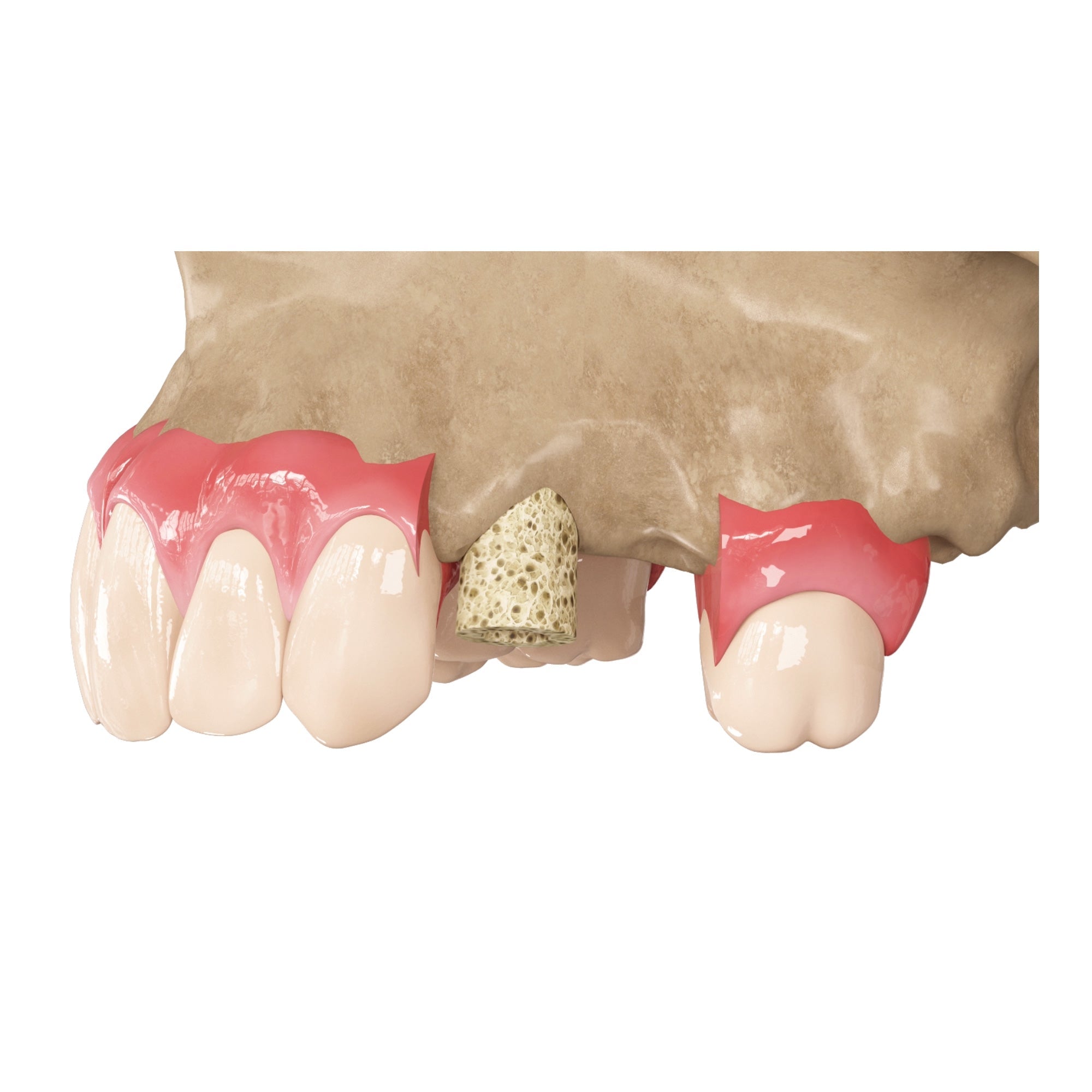 DSI Zenoss Bovine Natural Bone Graft Ring For Single Stage Treatment