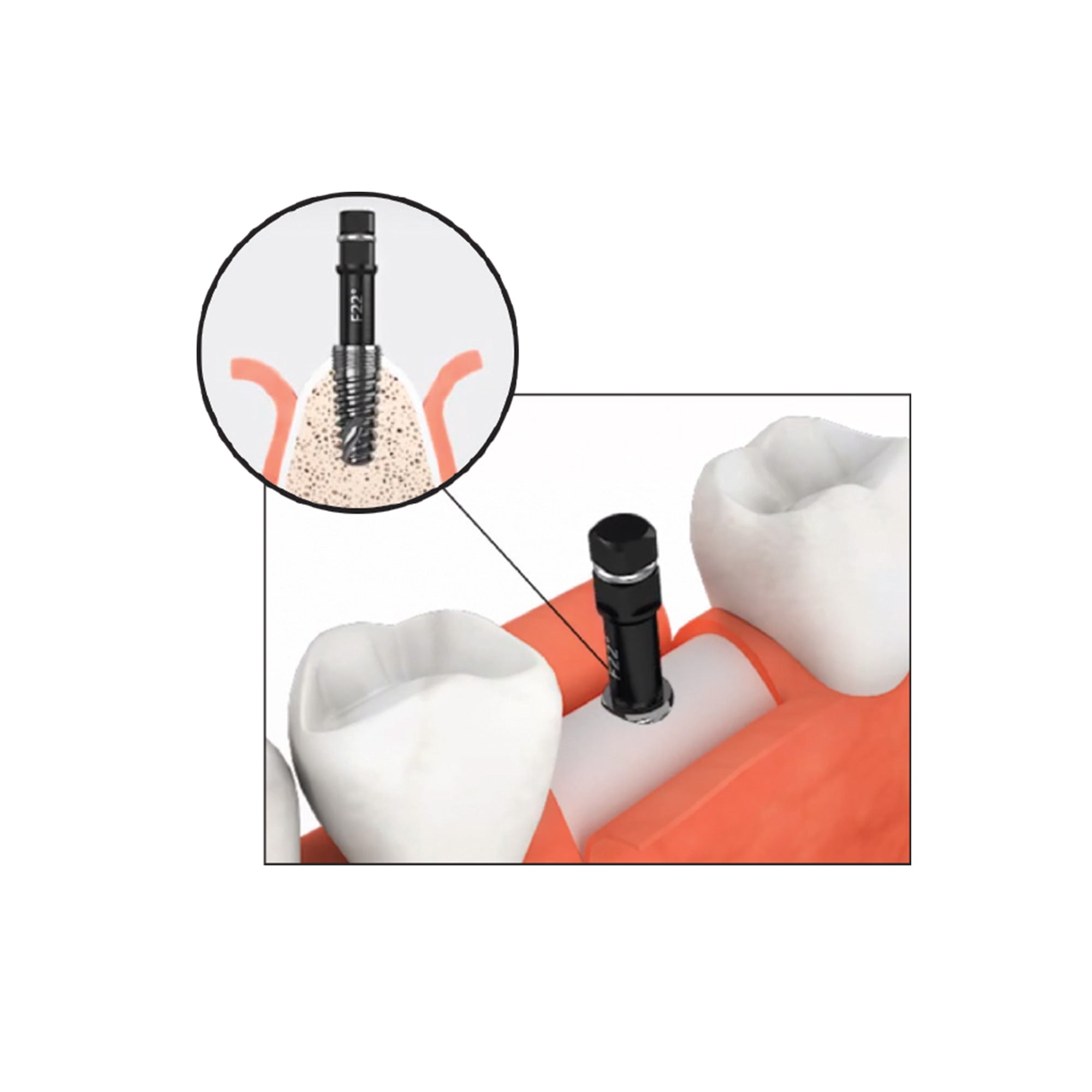 DS-RKS Carbide Fixture Removal (refill)