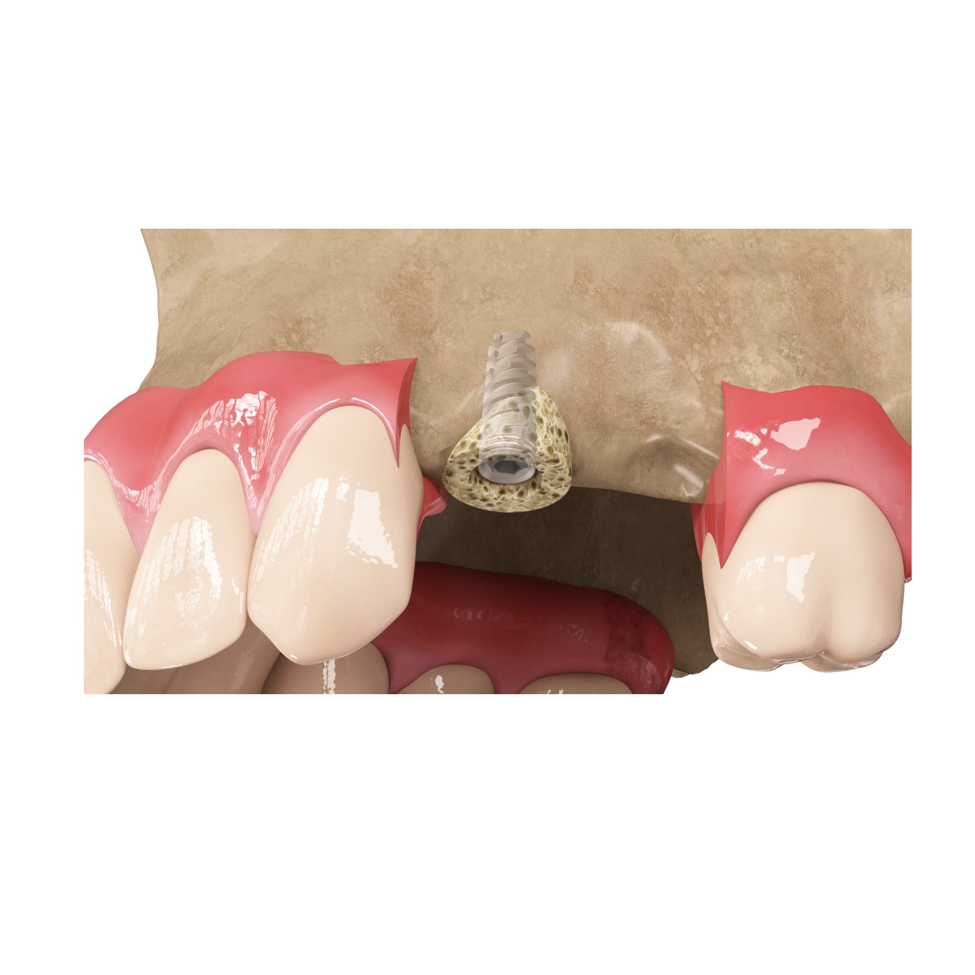 DSI Zenoss Bovine Natural Bone Graft Ring For Single Stage Treatment
