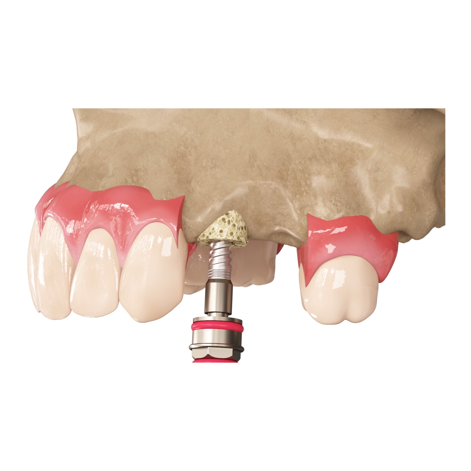 DSI Zenoss Bovine Natural Bone Graft Ring For Single Stage Treatment