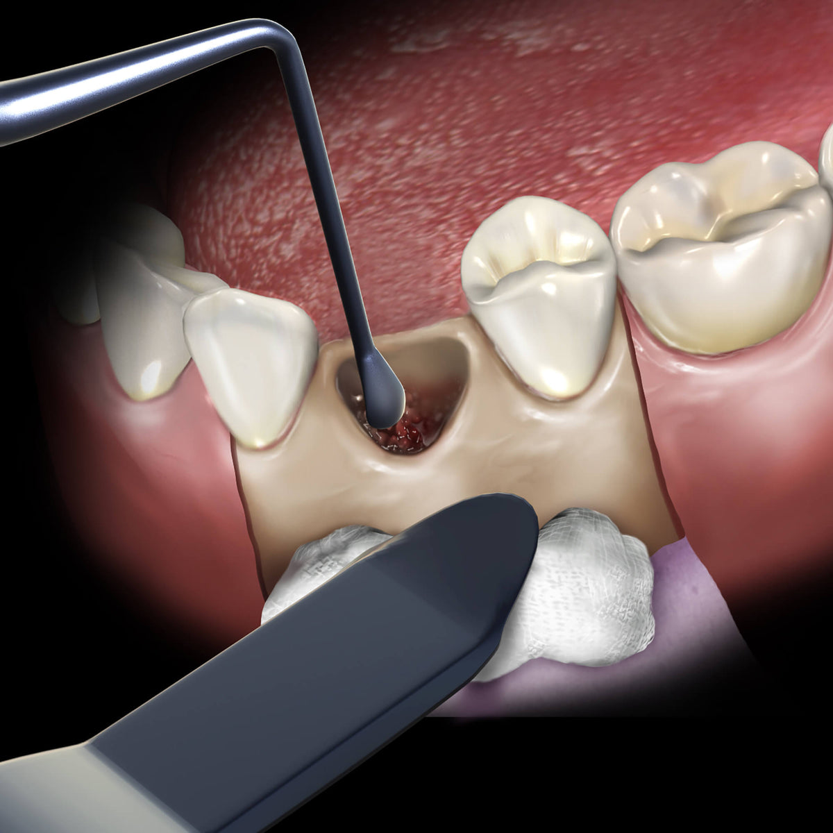 Retractor U of Minn. Black Line