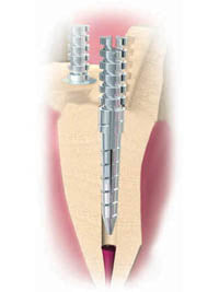 Flexi-Post Stainless Steel - Refill Kit - 30/Box
