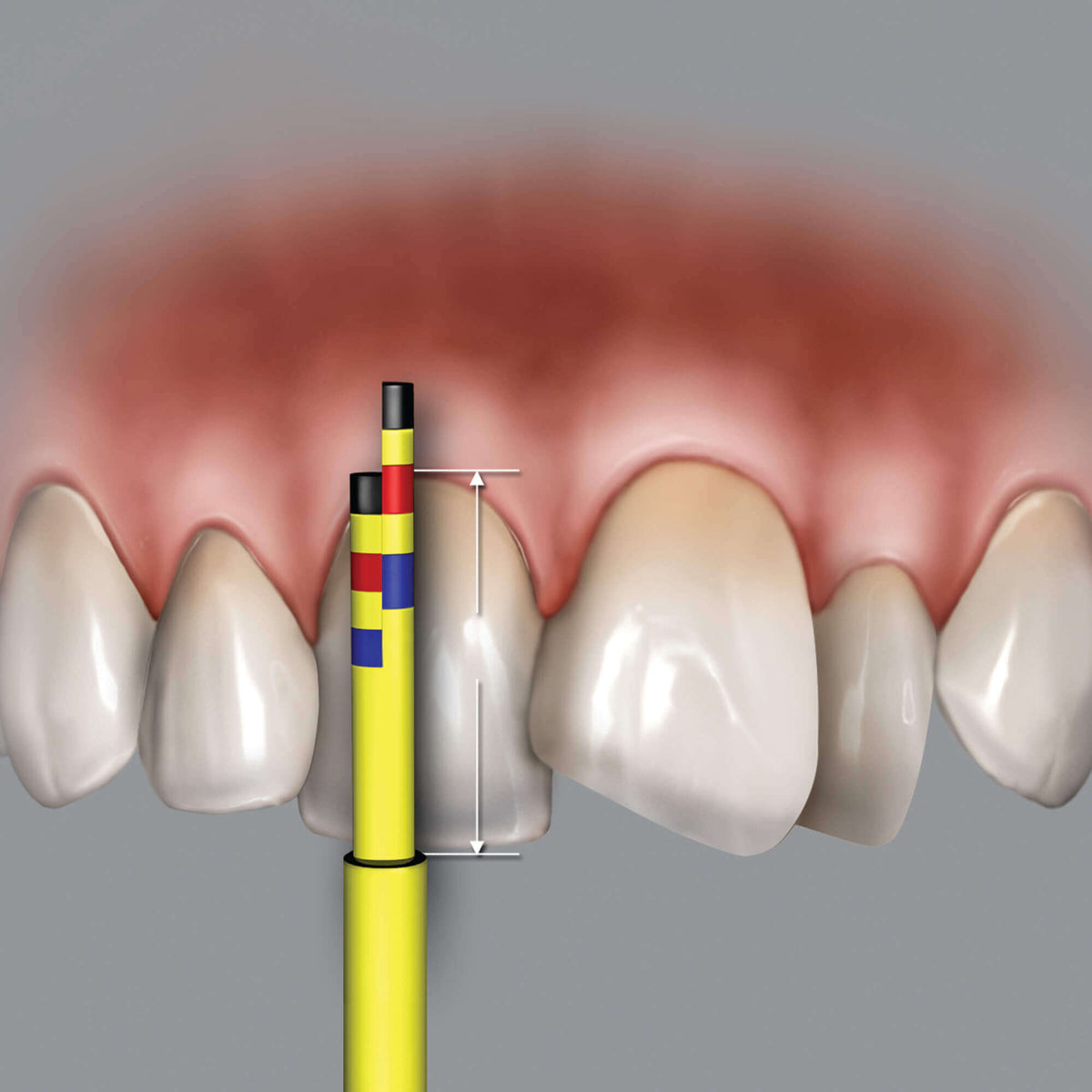 Inline Replacement Tips - 3 Trips