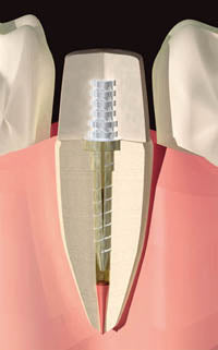 Flexi-Flange Titanium - Introductory Kit