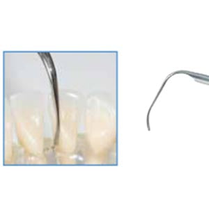 Biosonic Piezo Tips - Scaling