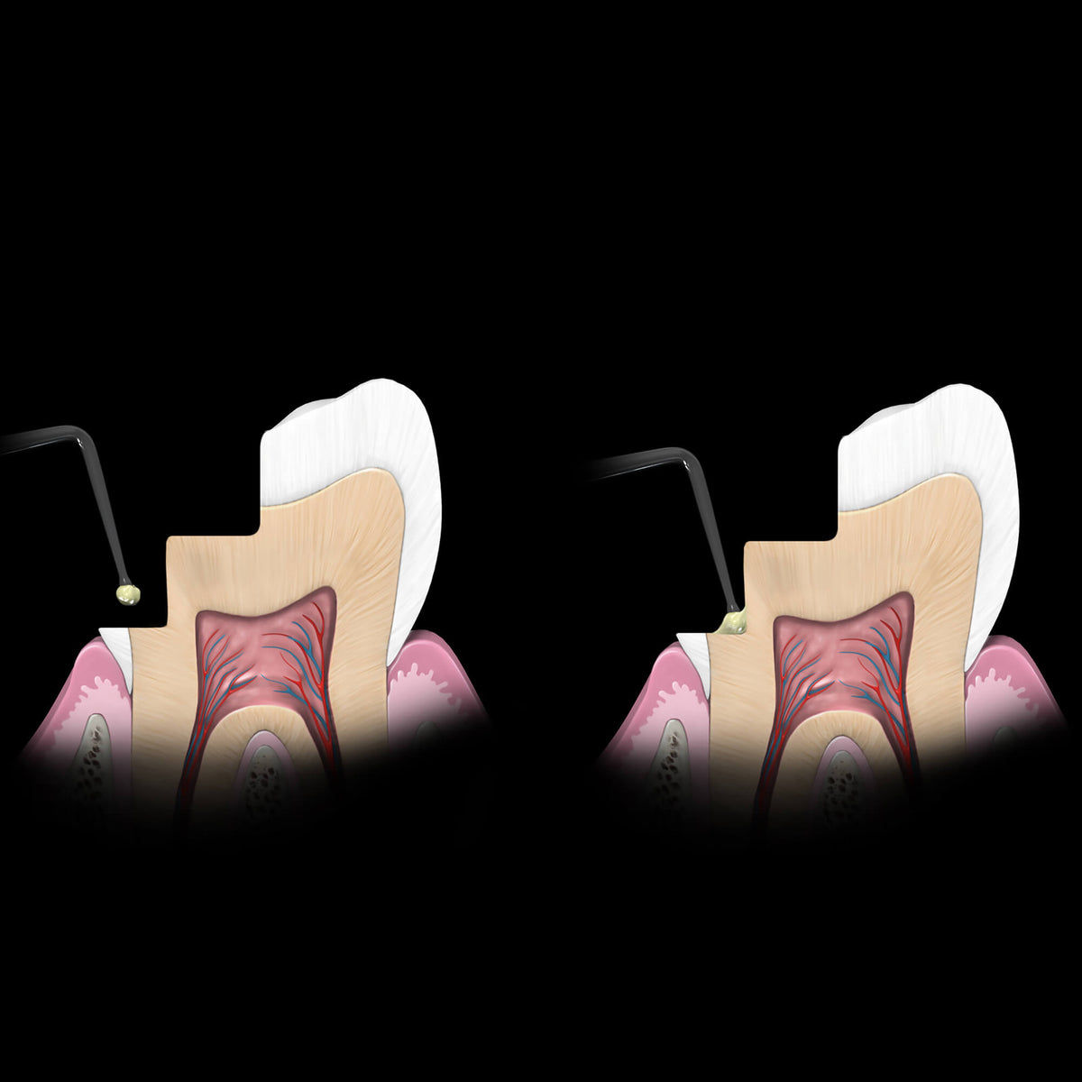 Micro Placement Composite Instrument