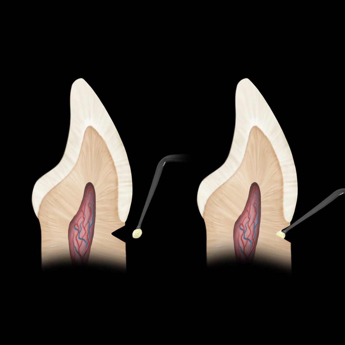 Micro Placement Composite Instrument